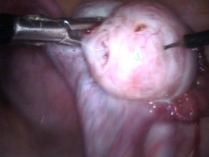 Diagnostic Laparoscopy Procedure in India