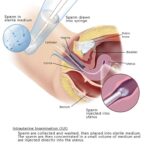 IMSI-treatment-erode